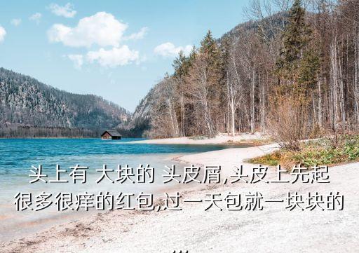 大塊頭皮屑,頭皮屑為何會(huì)大量脫發(fā)?原因何在?